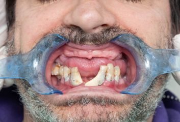rotten-teeth-during-inspection-with-retractor-for-2023-11-27-05-00-24-utc.jpg