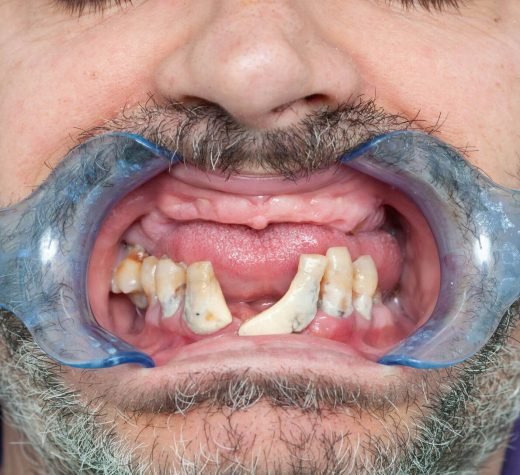 rotten-teeth-during-inspection-with-retractor-for-2023-11-27-05-00-24-utc.jpg